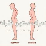 انحراف ستون فقرات