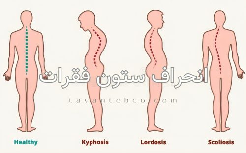 انحراف ستون فقرات