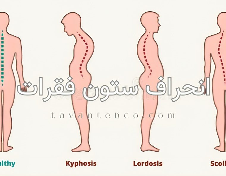 انحراف ستون فقرات