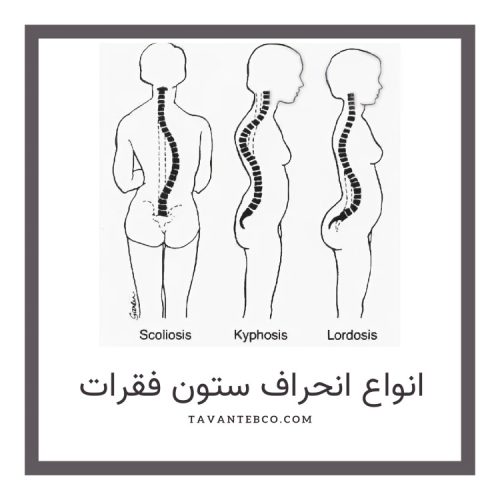 انواع انحراف ستون فقرات