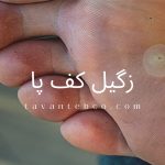 زگیل پا چیست ؟