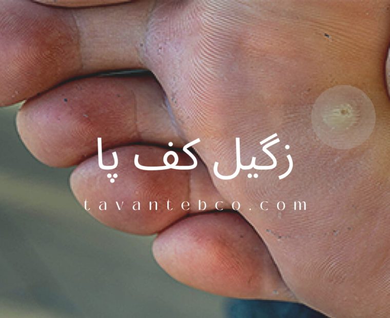 زگیل پا چیست ؟