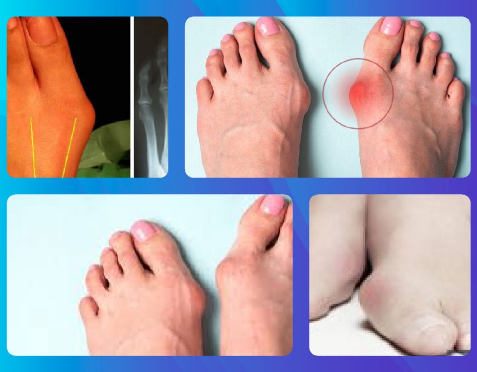 هالوکس والگوس