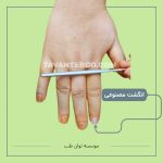 پروتز انگشت مصنوعی