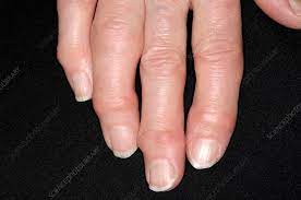 آرتروز و درد انگشتان دست