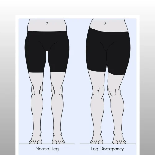 پای نرمال و پای کوتاه