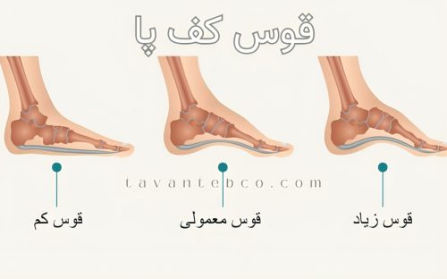 قوس زیاد کف پا