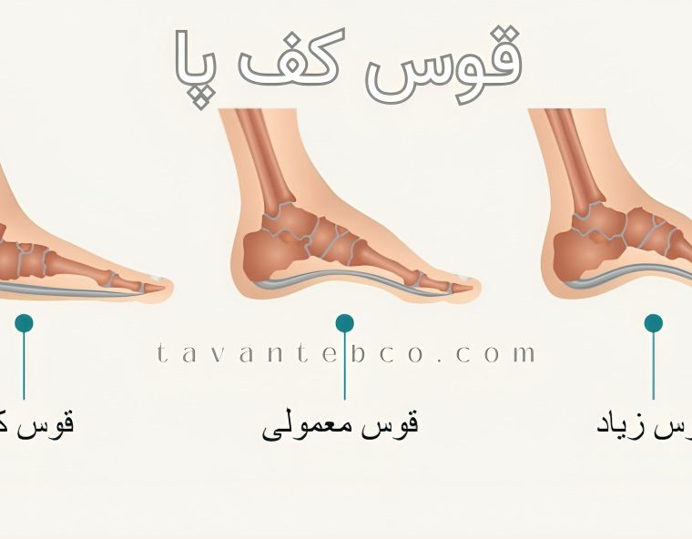 قوس زیاد کف پا
