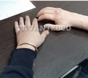 پروتز انگشت مصنوعی دست