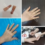 پروتز انگشت دست