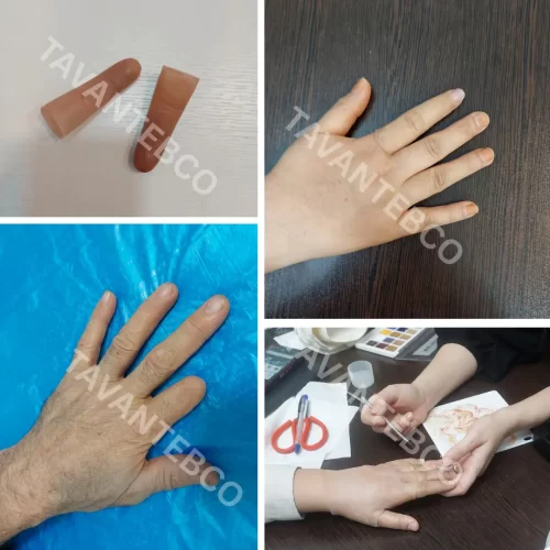 پروتز انگشت دست