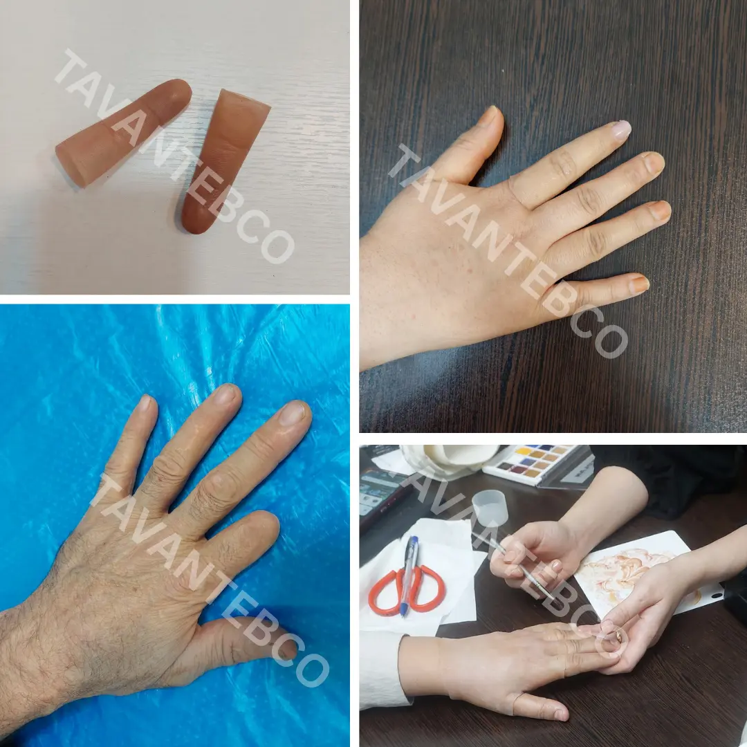 پروتز انگشت دست