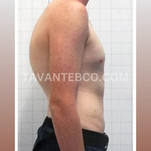 کایفوز(قوز کمر) / کیفوز