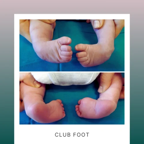 کلاب فوت (پاچنبری)