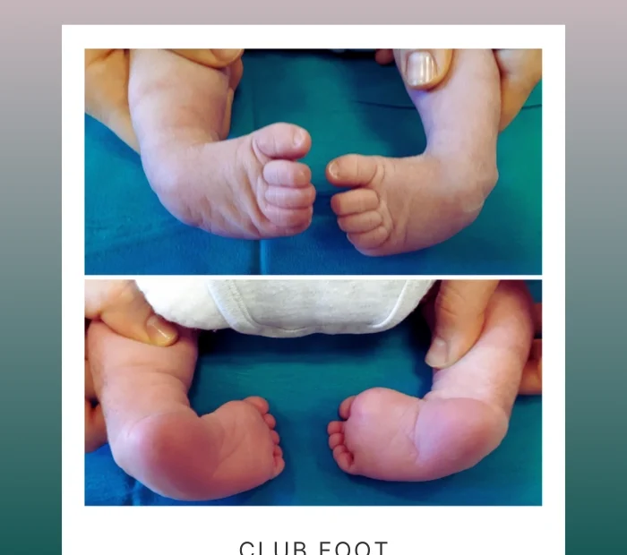 کلاب فوت (پاچنبری)