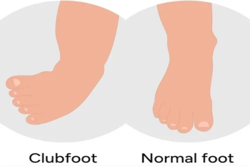 پای نرمال و کلاب فوت