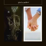 اسکولیوز و ازدواج
