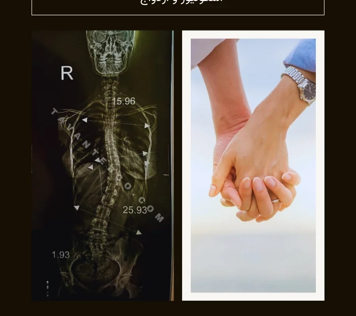 اسکولیوز و ازدواج