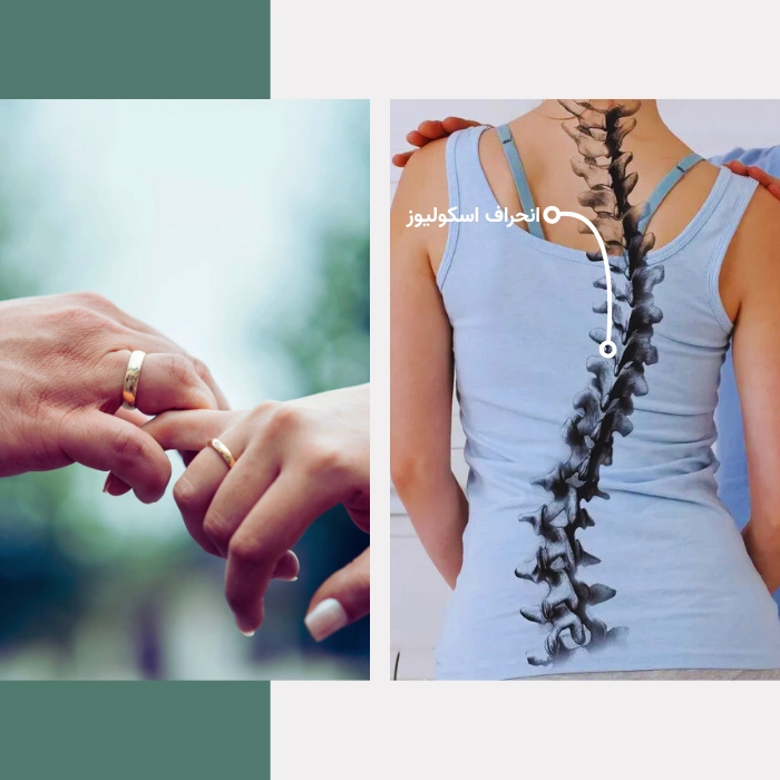 اسکولیوز و ازدواج